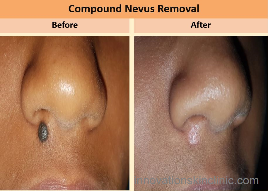 Compound Nevus Removal 1